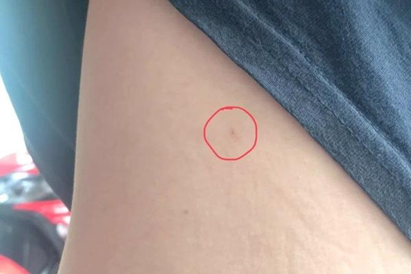 Xác minh thông tin bị chích kim tiêm khi đi dạo trong khu đô thị Sala-2