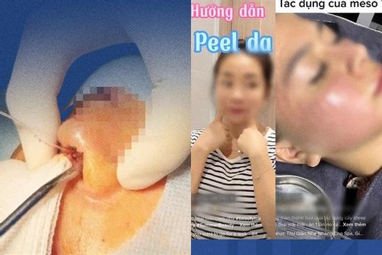 Nát mũi, hỏng mặt, biến chứng thai kì vì 'bác sĩ TikTok'