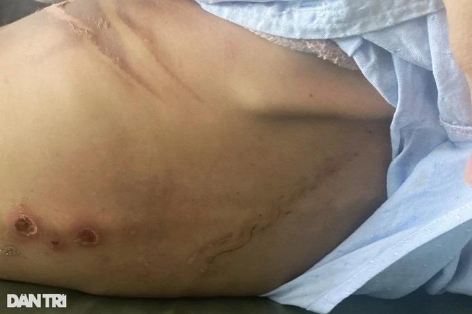 Cấp cứu bé 2 tuổi ở TPHCM người đầy vết thương, nghi bị cha bạo hành 3 ngày-2