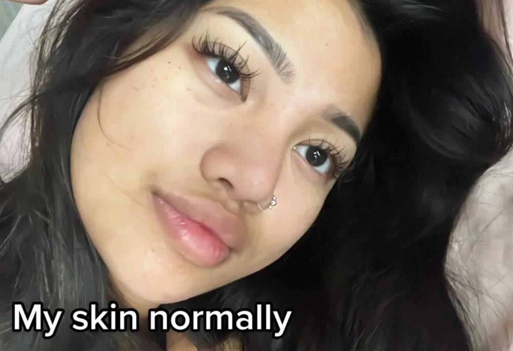 Cô gái 22 tuổi nhiễm giun đũa khắp mặt do dùng chung cọ trang điểm-1