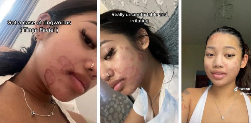 Cô gái 22 tuổi nhiễm giun đũa khắp mặt do dùng chung cọ trang điểm-2