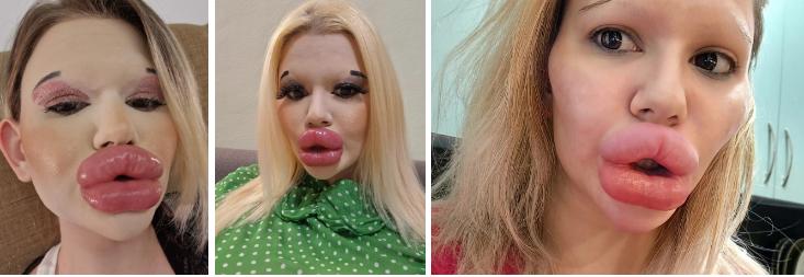 Kinh hoàng cô gái biến dạng vì thẩm mỹ dù tốn hơn nửa tỷ-2