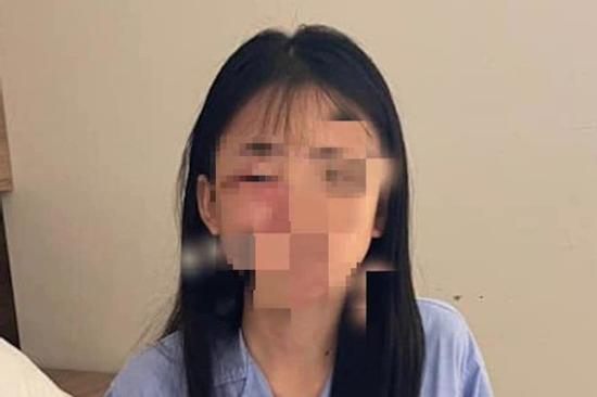 Công an giám định thương tích nữ sinh lớp 8 bị đánh hội đồng