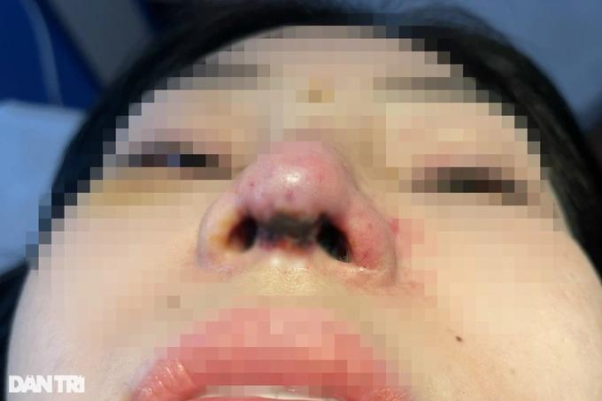 16 điều cần nhớ kỹ khi nâng mũi để không ôm hận vì bác sĩ tiktok-1