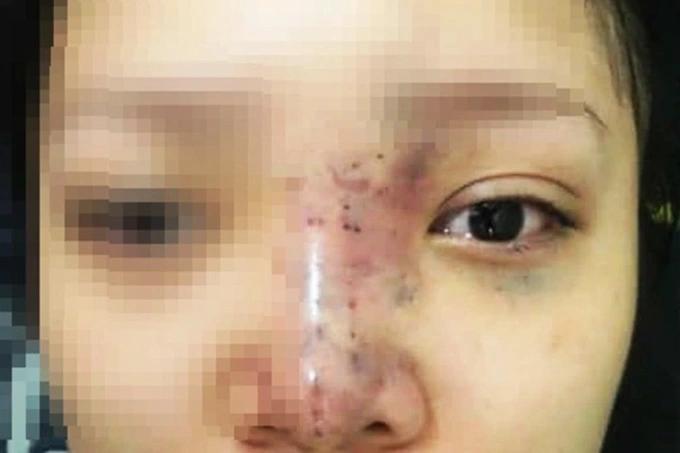 16 điều cần nhớ kỹ khi nâng mũi để không ôm hận vì bác sĩ tiktok-2