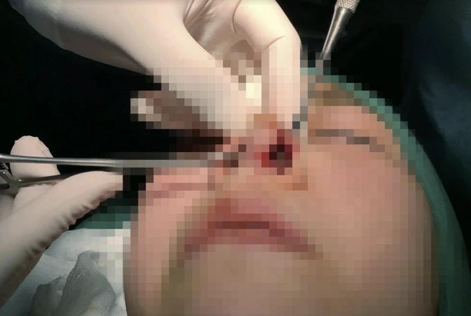 16 điều cần nhớ kỹ khi nâng mũi để không ôm hận vì bác sĩ tiktok-3