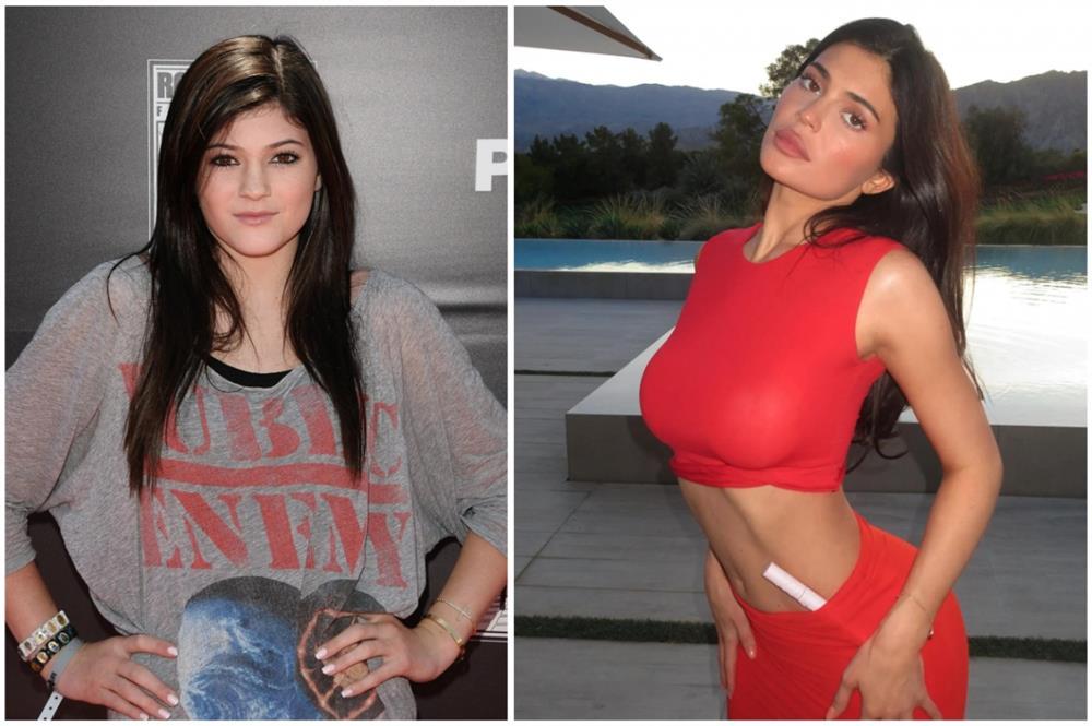 Kylie Jenner bị chỉ trích nói dối khi tuyên bố không thẩm mỹ-2