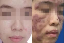 Cô gái 19 tuổi biến dạng mặt, nguy cơ mù vì đơn thuốc của 'bác sĩ online'