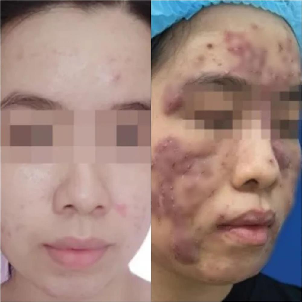 Cô gái 19 tuổi biến dạng mặt, nguy cơ mù vì đơn thuốc của bác sĩ online-1