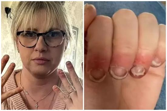 Đắp móng gel suốt nhiều năm, người phụ nữ gặp hậu quả đáng sợ