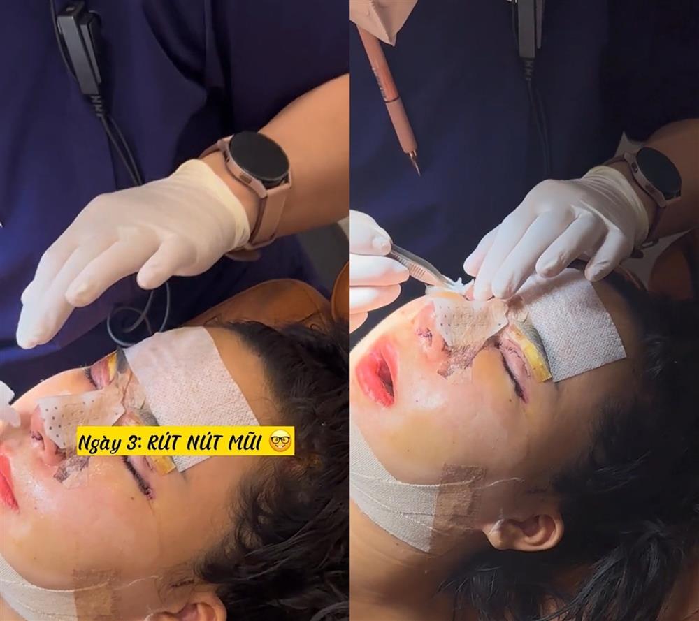 Chị Ông Địa chi 2 tỷ thẩm mỹ, giảm 17kg như thay da đổi thịt-3