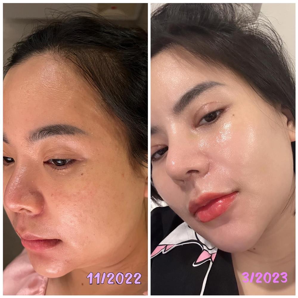 Chị Ông Địa chi 2 tỷ thẩm mỹ, giảm 17kg như thay da đổi thịt-7