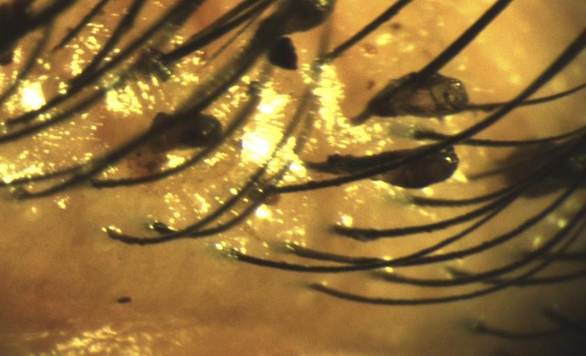 Ổ rận mu trên mi mắt người phụ nữ 50 tuổi-1