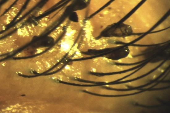 Ổ rận mu trên mi mắt người phụ nữ 50 tuổi