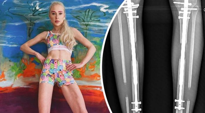 Nữ người mẫu bị chỉ trích vì bỏ hơn 3 tỷ kéo dài chân để cao đến 1m8-2