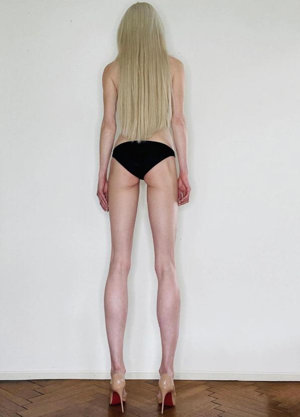 Nữ người mẫu bị chỉ trích vì bỏ hơn 3 tỷ kéo dài chân để cao đến 1m8-3
