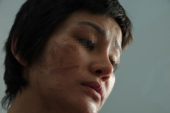 Lời kể người phụ nữ mang thai 7 tháng bị chồng bạo hành dã man-1