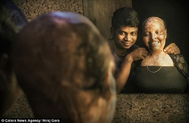 Tìm được chân tình sau khi bị bạn trai cuồng yêu tạt axit đến mù lòa-5