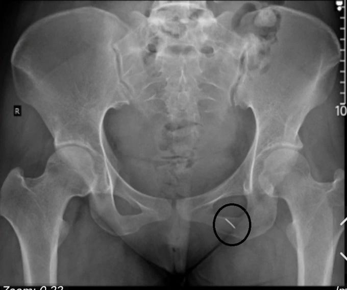 Thủ kim phòng thượng mã phong đêm tân hôn, cô gái bị kim chui vào người-1