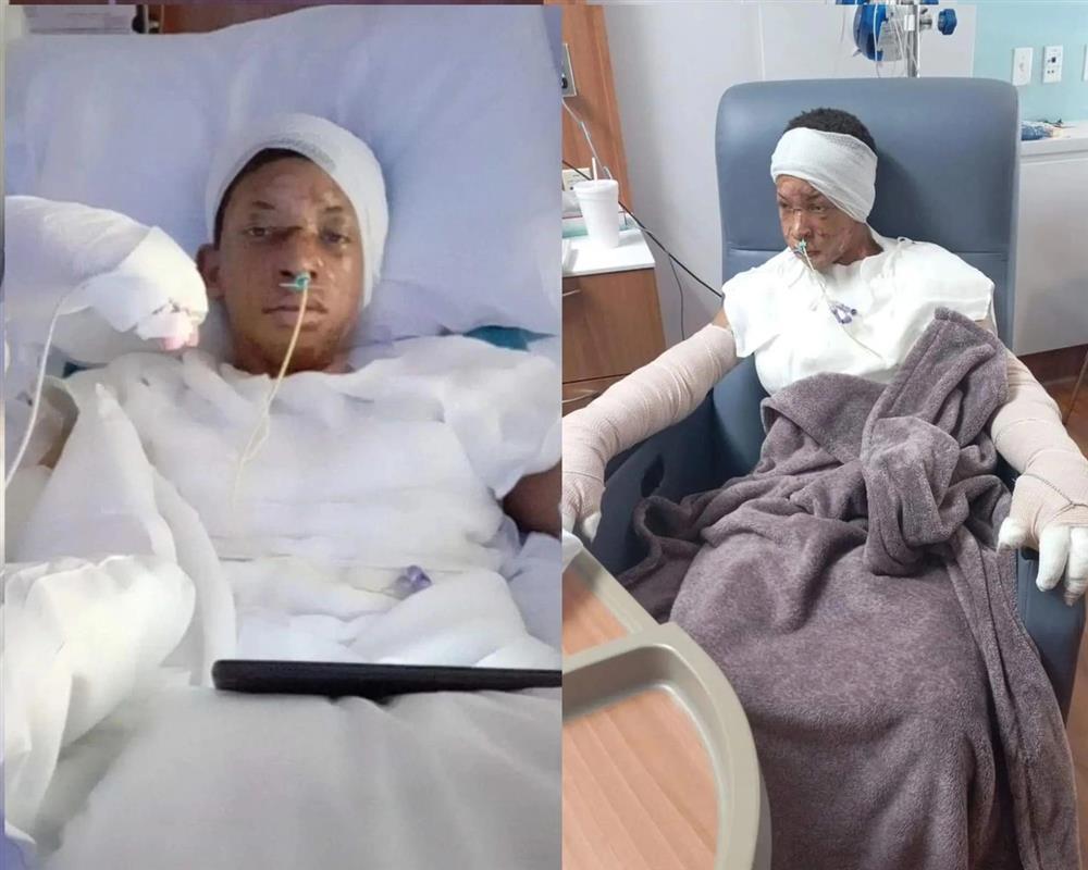 Bắt chước trào lưu đổ cồn vào lửa, cậu bé Mỹ suýt bị thiêu sống-1