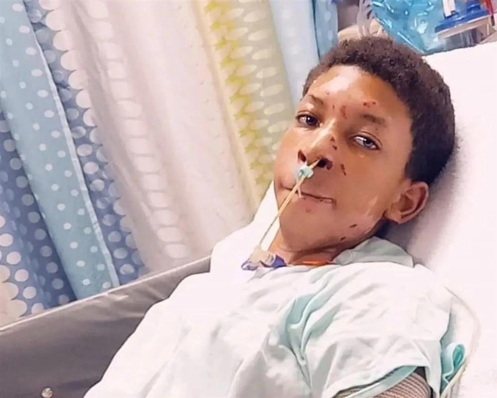 Bắt chước trào lưu đổ cồn vào lửa, cậu bé Mỹ suýt bị thiêu sống-2