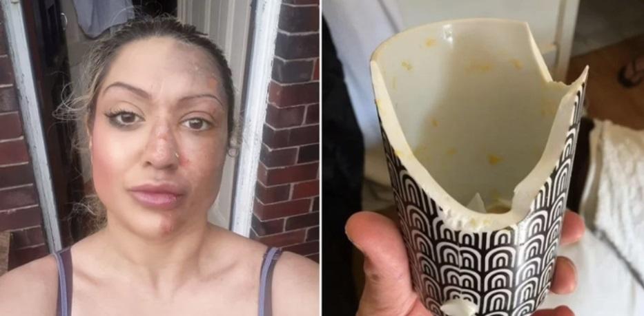 Luộc trứng ở lò vi sóng, người phụ nữ gặp sự cố khiến mặt bị hủy hoại-2