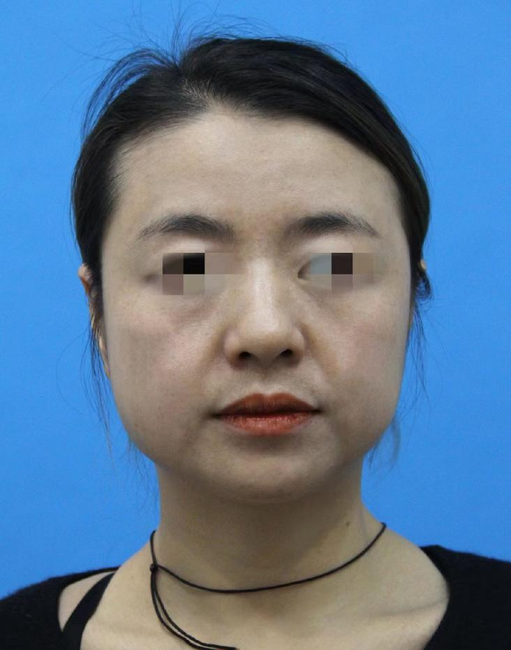 Cắt da mặt được 1 tháng, người phụ nữ 48 tuổi cải lão hoàn đồng, biến thành người khác-2