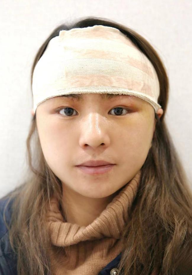 Cắt da mặt được 1 tháng, người phụ nữ 48 tuổi cải lão hoàn đồng, biến thành người khác-3