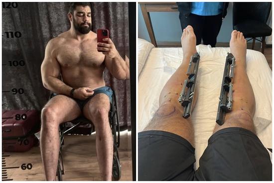 Anh chàng cơ bắp chi 100.000 USD để làm phẫu thuật cao hơn vợ