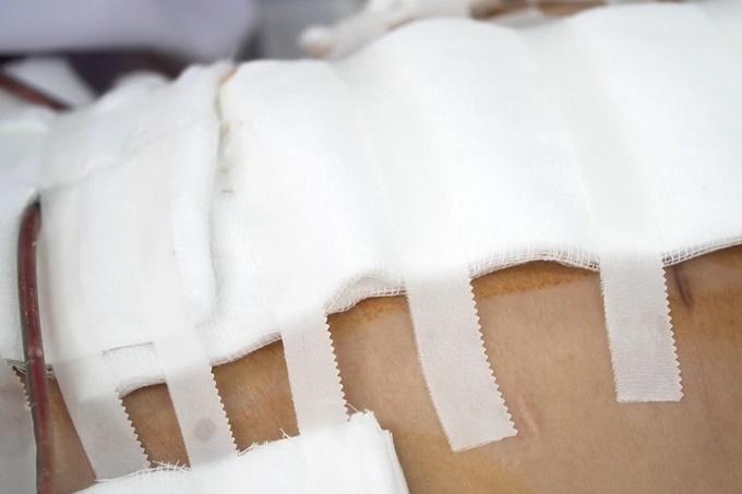 Người phụ nữ ở TPHCM hôn mê, mổ cấp cứu mất 6 lít máu sau khi đi hút mỡ-1