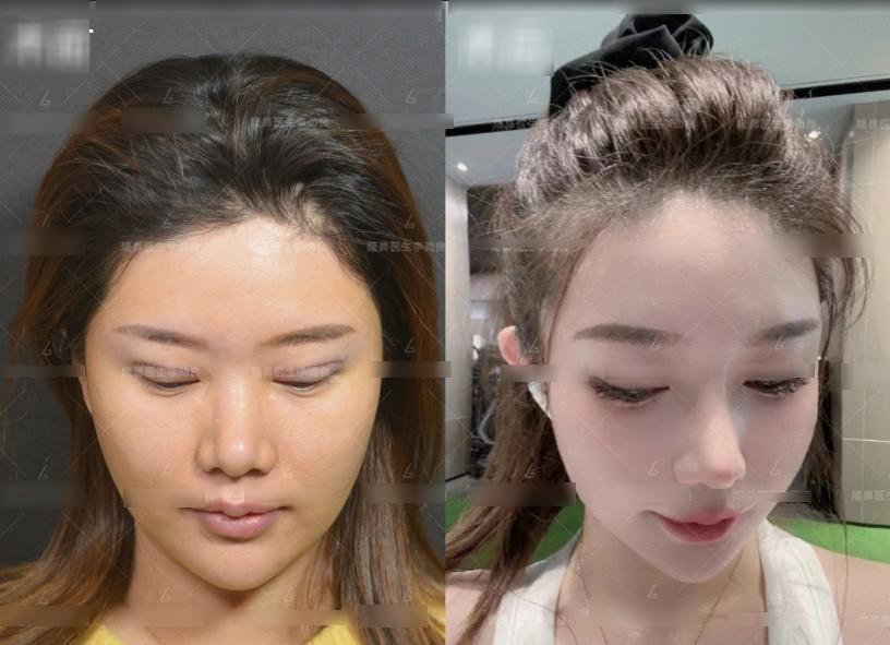 Muốn đẹp nhưng không đụng dao kéo, cô gái xỏ 16 sợi chỉ vào mũi và cái kết-1