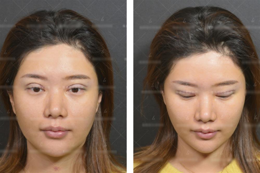 Muốn đẹp nhưng không đụng dao kéo, cô gái xỏ 16 sợi chỉ vào mũi và cái kết-2