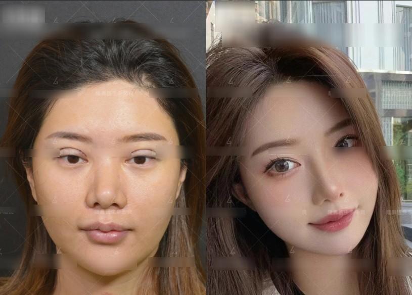 Muốn đẹp nhưng không đụng dao kéo, cô gái xỏ 16 sợi chỉ vào mũi và cái kết-3