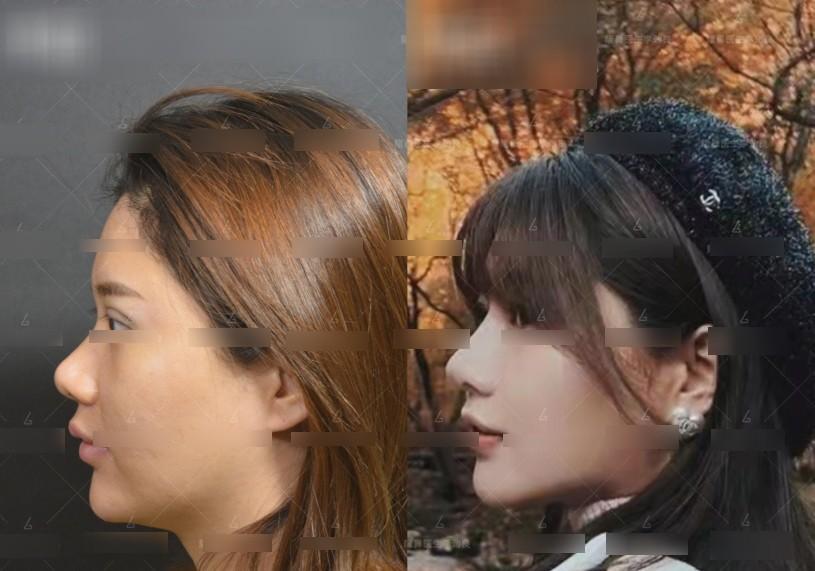 Muốn đẹp nhưng không đụng dao kéo, cô gái xỏ 16 sợi chỉ vào mũi và cái kết-4