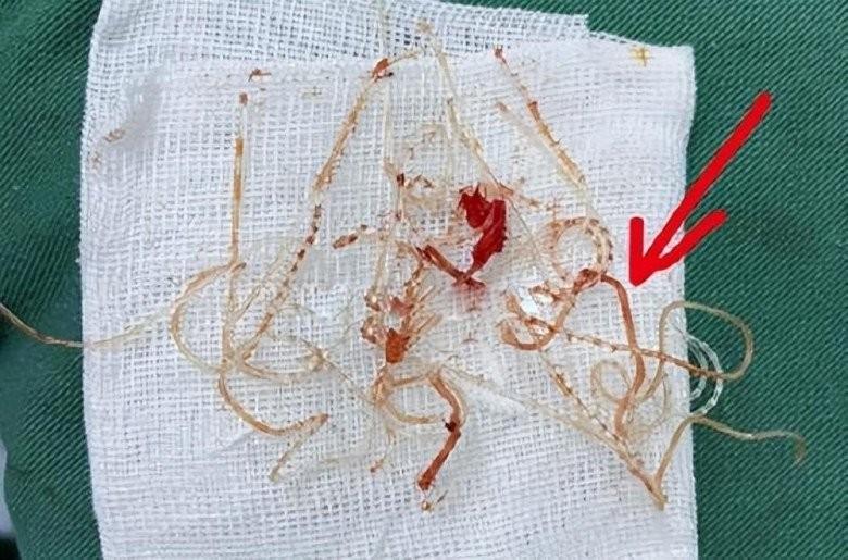 Muốn đẹp nhưng không đụng dao kéo, cô gái xỏ 16 sợi chỉ vào mũi và cái kết-8