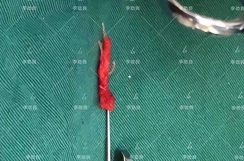 Muốn đẹp nhưng không đụng dao kéo, cô gái xỏ 16 sợi chỉ vào mũi và cái kết-9