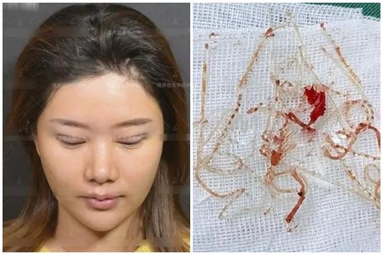 Muốn đẹp nhưng không đụng 'dao kéo', cô gái xỏ 16 sợi chỉ vào mũi và cái kết