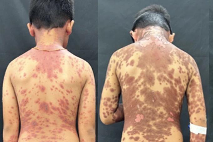Bé trai 10 tuổi biến dạng da nặng nề sau khi uống thuốc động kinh-1