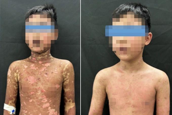 Bé trai 10 tuổi biến dạng da nặng nề sau khi uống thuốc động kinh-2