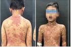 Bé trai 10 tuổi biến dạng da nặng nề sau khi uống thuốc động kinh