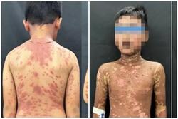Bé trai 10 tuổi biến dạng da nặng nề sau khi uống thuốc động kinh