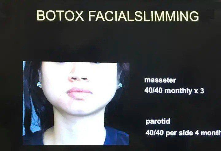 10 năm tiêm botox liên tục, cô gái từ mặt vuông thành cằm Vline-2
