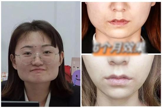 10 năm tiêm botox liên tục, cô gái từ mặt vuông thành cằm Vline