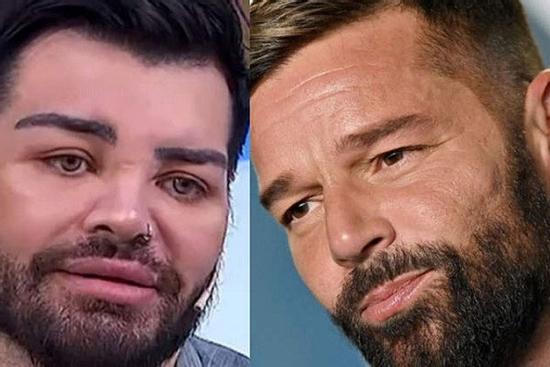 Chịu đau đớn và di chứng của 40 ca thẩm mỹ để trông giống thần tượng