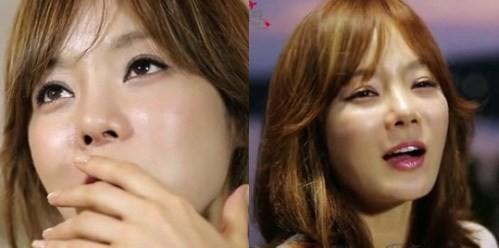 Nữ thần Chae Rim và hành trình lấy lại nhan sắc sau di chứng phẫu thuật thẩm mỹ-5