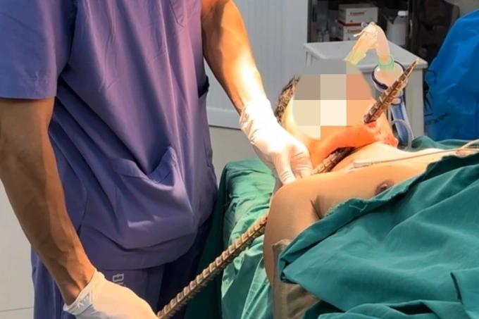 Thanh xà beng dài 90cm đâm xuyên cổ người bệnh-1