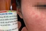 Hà Nội: Cô gái sốc nặng vì nách đổi màu sau khi lột da tại spa-2