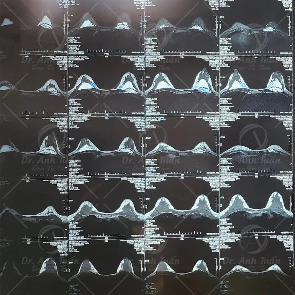 Nâng cấp vòng 1 không cần phẫu thuật, bác sĩ cảnh báo cẩn trọng kẻo tiền mất tật mang-1