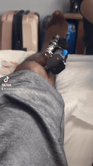 Bị bạn gái chê lùn vì cao có 1m65, chàng trai chi gần 2 tỷ để kéo dài chân-1