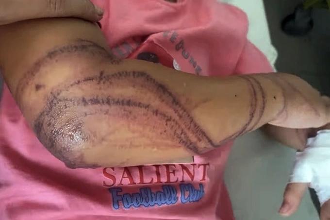 TPHCM: Hàng loạt người vào viện cầu cứu vì đi tắm biển gặp họa bỏng sứa-1